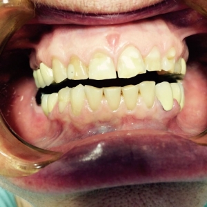 Патологическая стираемость нижних и верхних зубов
