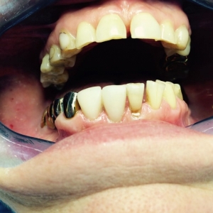 После реставрация нижних зубов