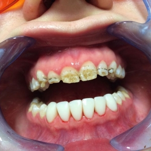 Гипоплазия эмали верхних зубов