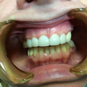Реставрация  верхних зубов