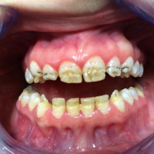 Гипоплазия эмали верхних и нижних зубов