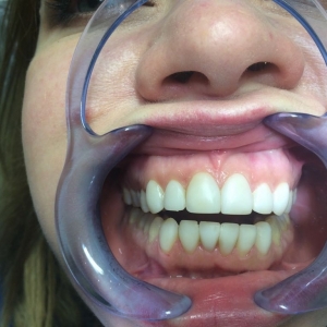 Реставрация   верхних и нижних зубов