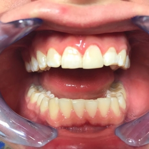 После реставрация верхних зубов