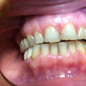 Патологическая стираемость верхних зубов