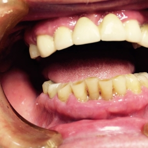 Патологическая стираемость нижних  зубов