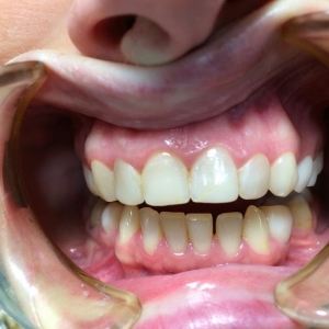 После реставрация верхних зубов